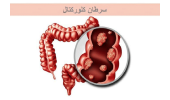 اجرای طرح بررسی عوامل خطر و خصوصیات سرطان روده در جهاددانشگاهی فارس